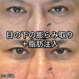 目の下のふくらみ取り
