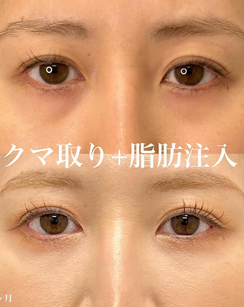 目の下のふくらみ取り