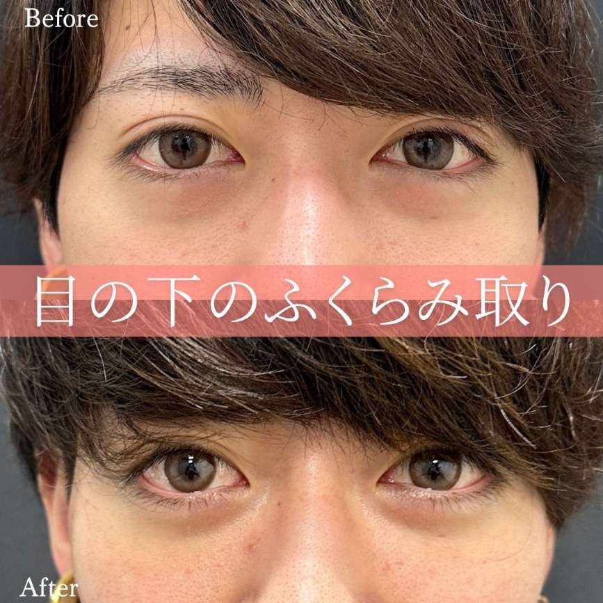 目の下のふくらみ取り