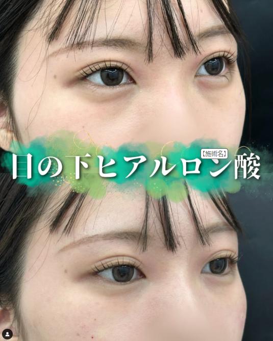 目の下のふくらみ取り