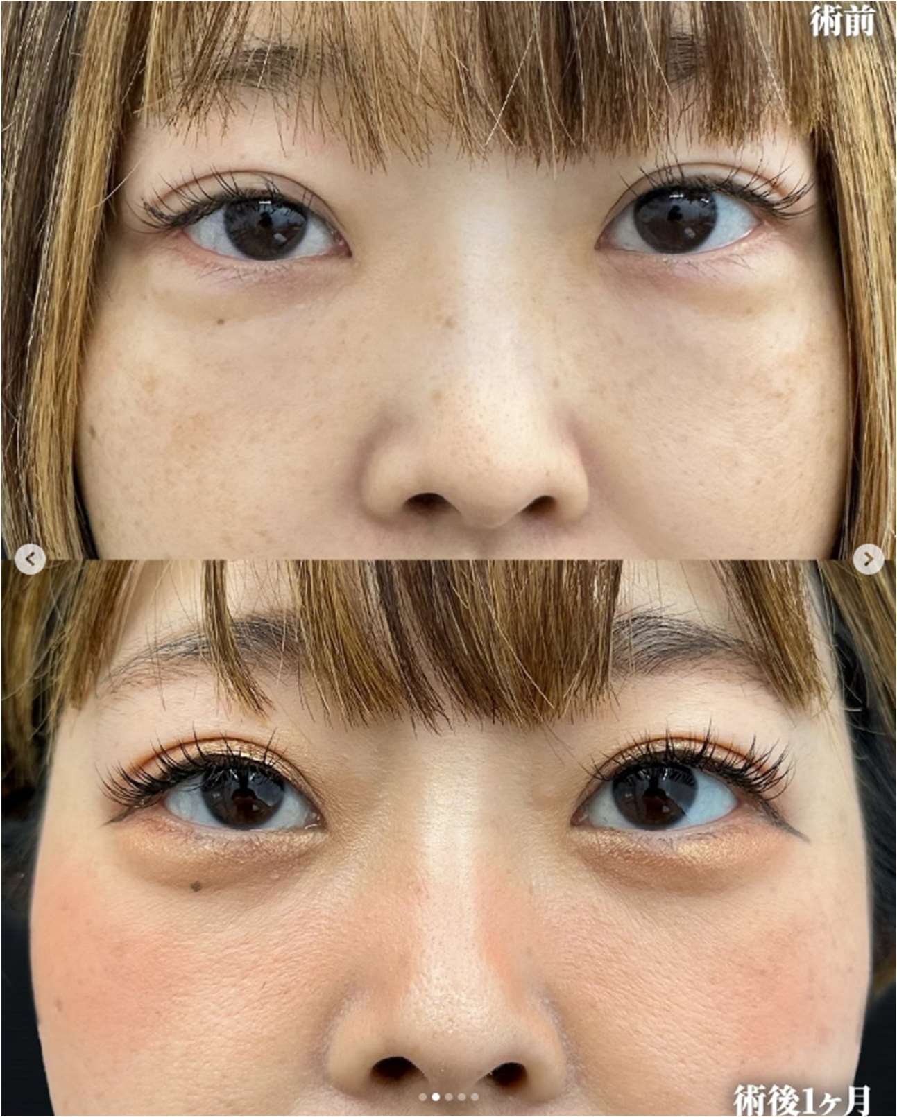 目の下のふくらみ取り