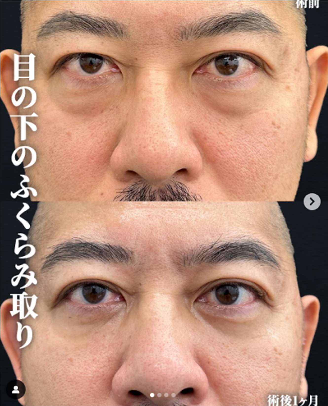 目の下のふくらみ取り