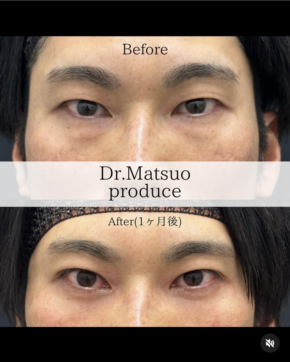 目の下のふくらみ取り