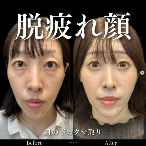 目の下のふくらみ取り