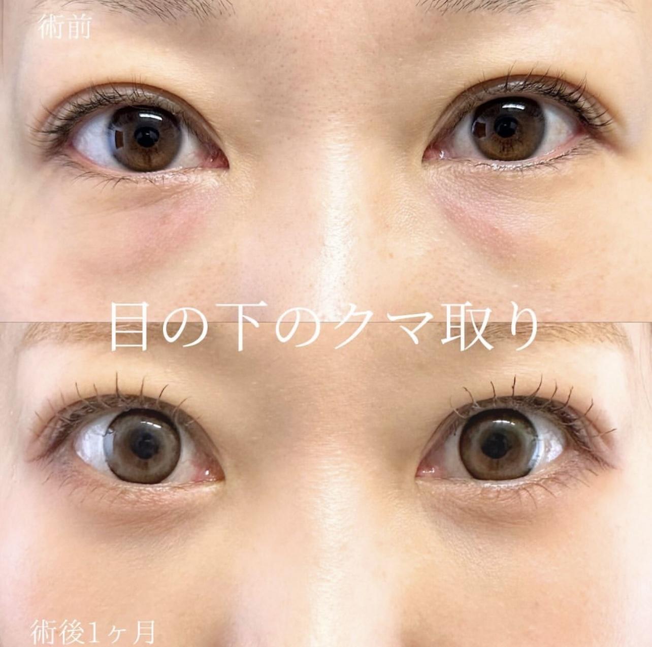 目の下のふくらみ取り
