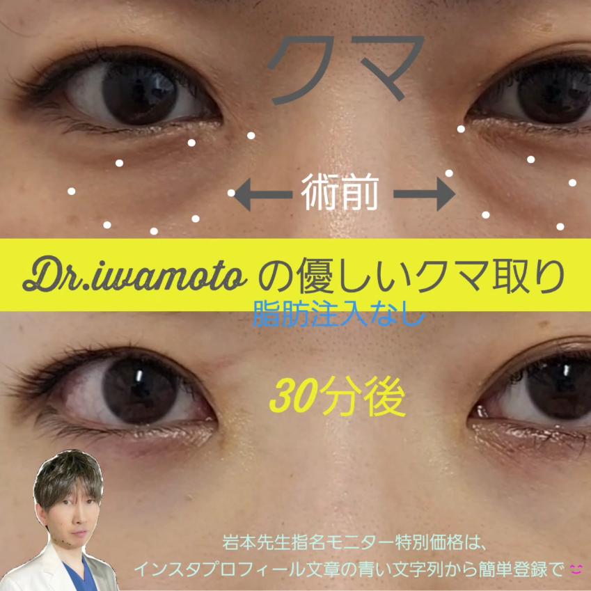 目の下のふくらみ取り