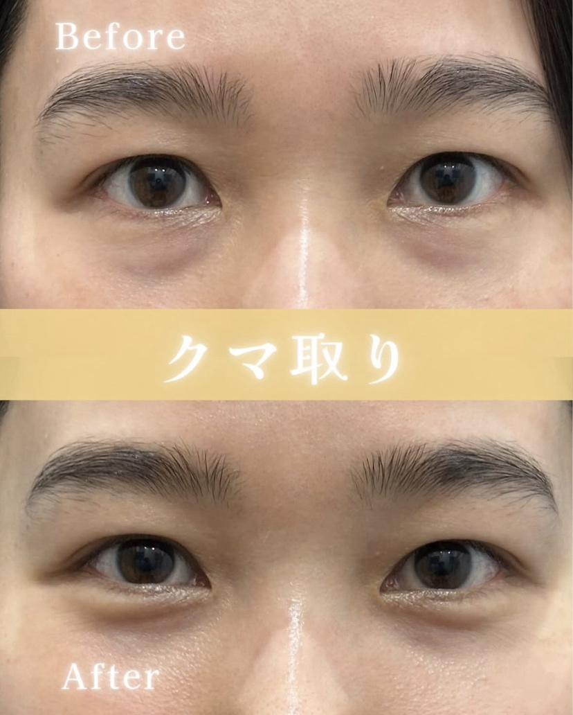 目の下のふくらみ取り
