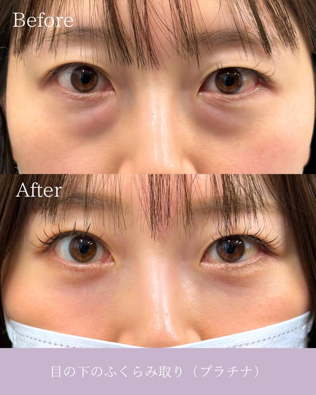 目の下のふくらみ取り
