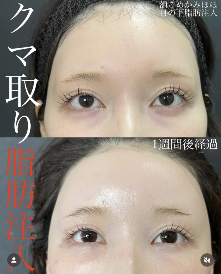 目の下のふくらみ取り