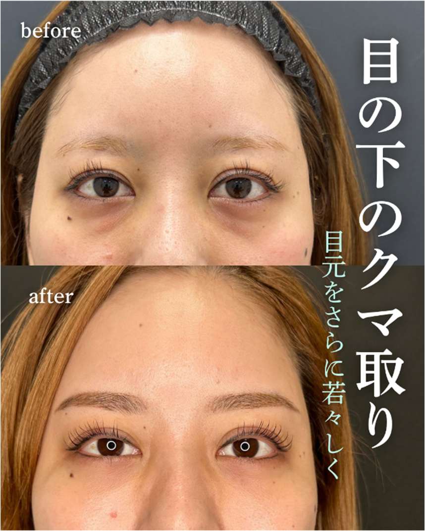 目の下のふくらみ取り