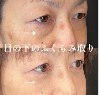目の下のふくらみ取り