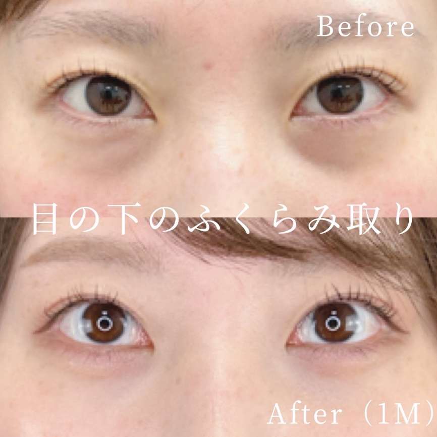 目の下のふくらみ取り