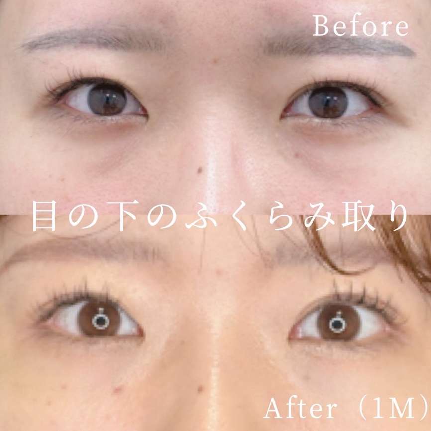 目の下のふくらみ取り