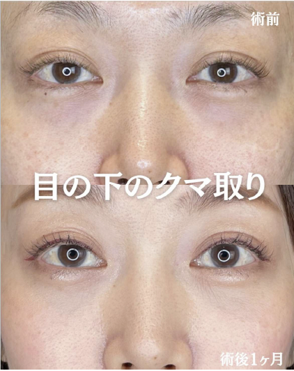 目の下のふくらみ取り