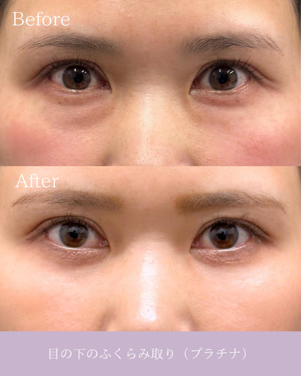 目の下のふくらみ取り