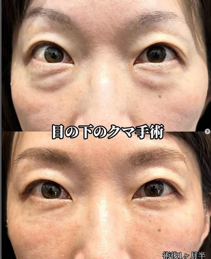 目の下のふくらみ取り