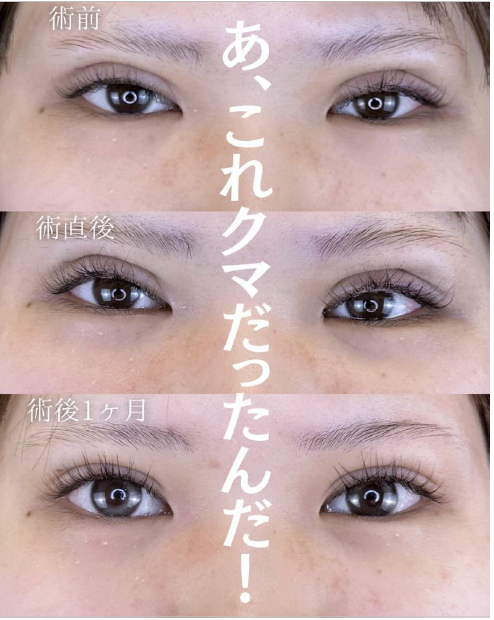 目の下のふくらみ取り