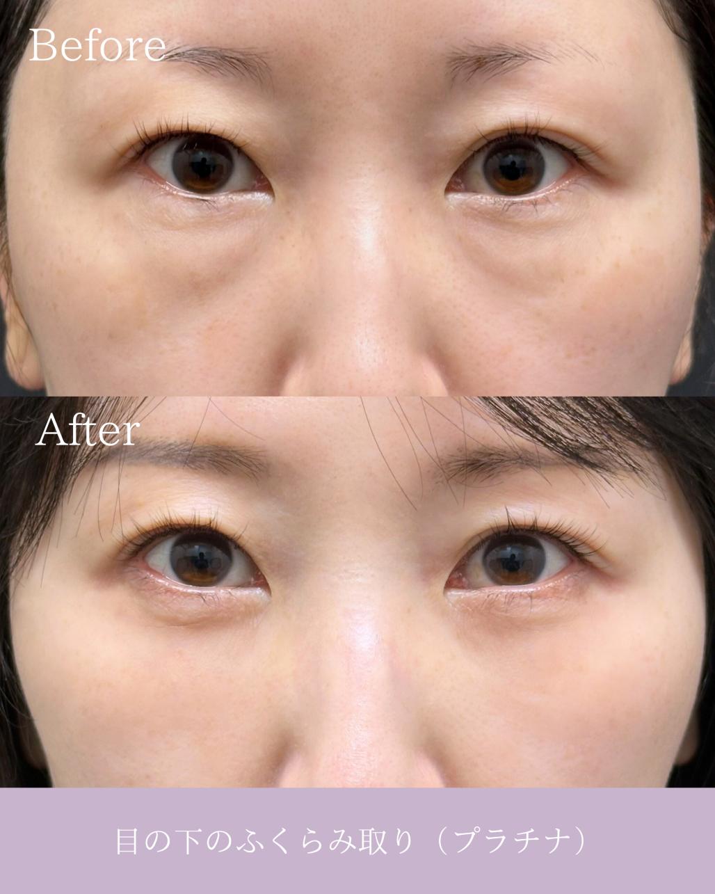 目の下のふくらみ取り