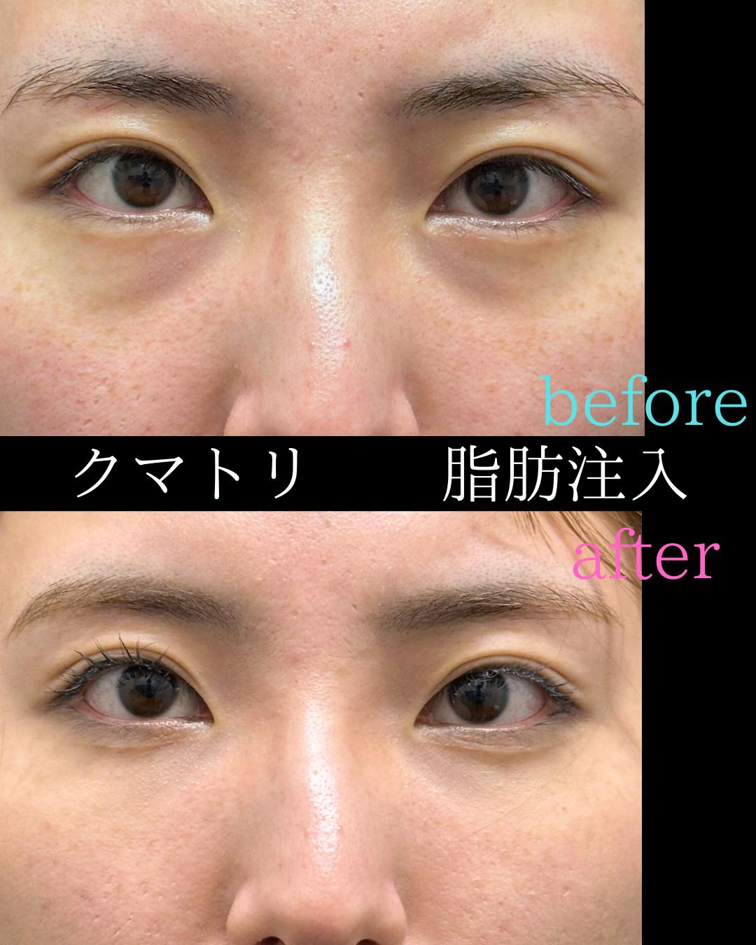 目の下のふくらみ取り