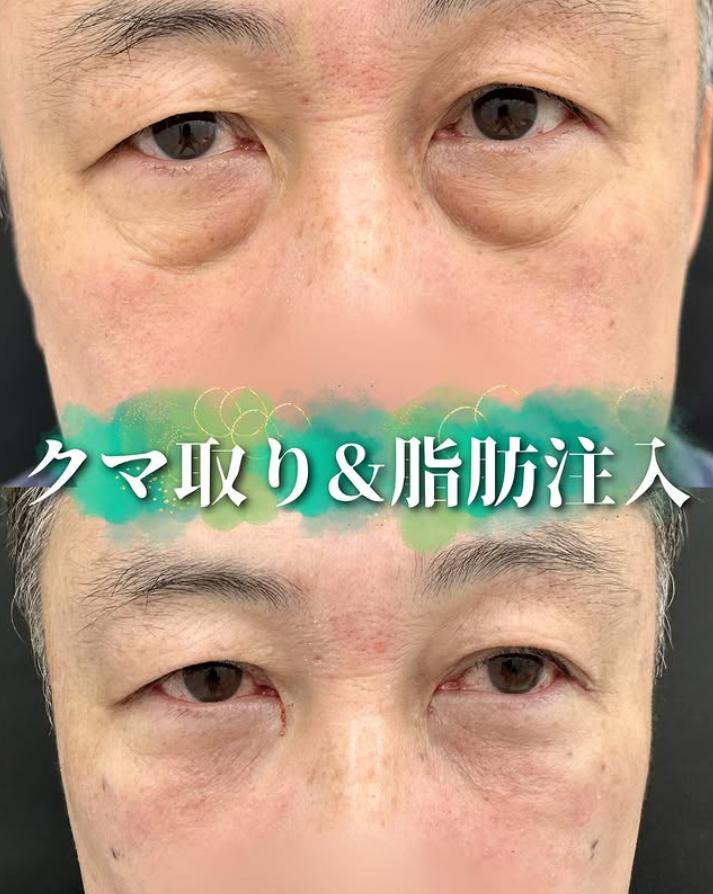 目の下のふくらみ取り