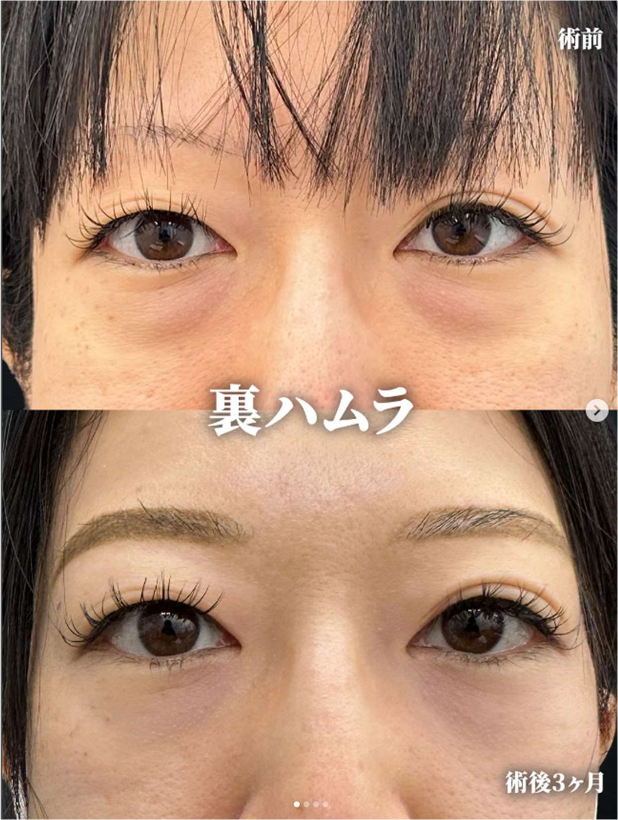 目の下のふくらみ取り