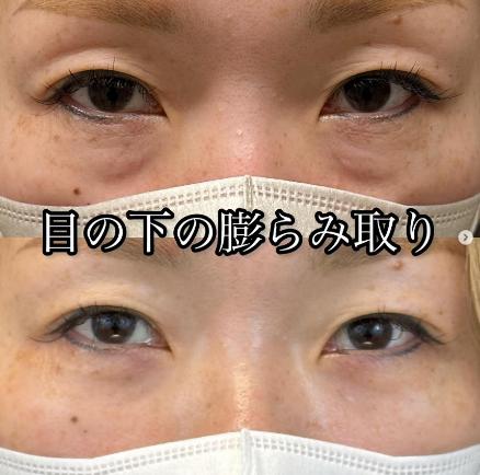 目の下のふくらみ取り
