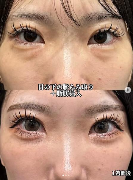 目の下のふくらみ取り