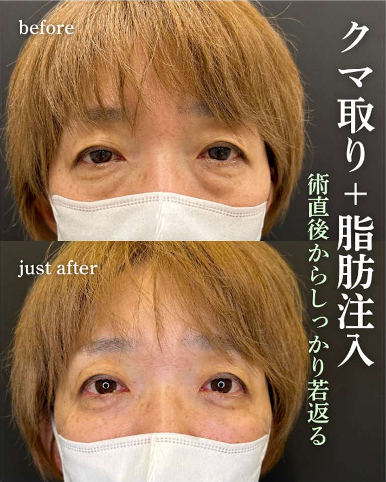 目の下のふくらみ取り