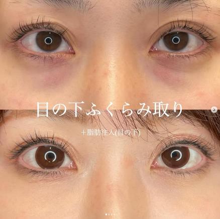 目の下のふくらみ取り