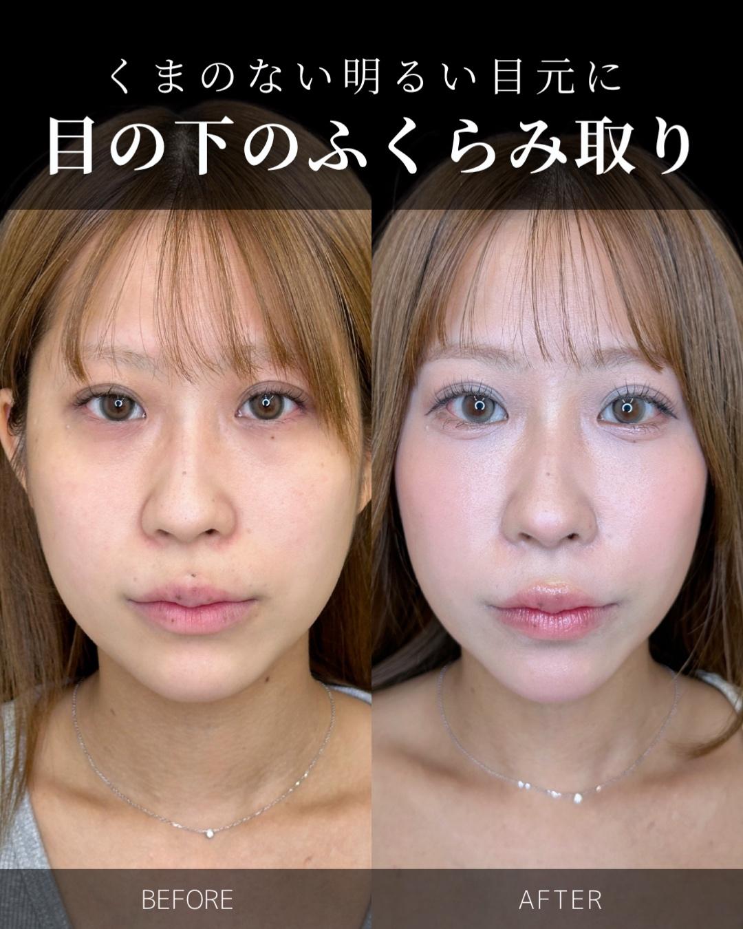 目の下のふくらみ取り