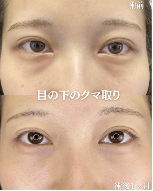 目の下のふくらみ取り