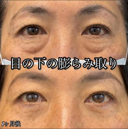 目の下のふくらみ取り