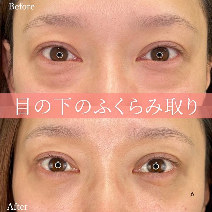 目の下のふくらみ取り