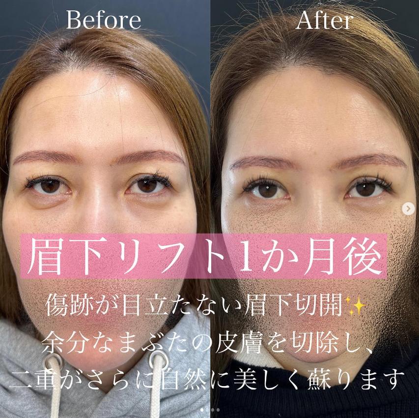 眉下リフトの症例写真