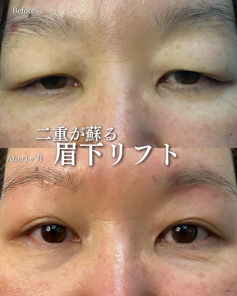眉下リフトの症例写真