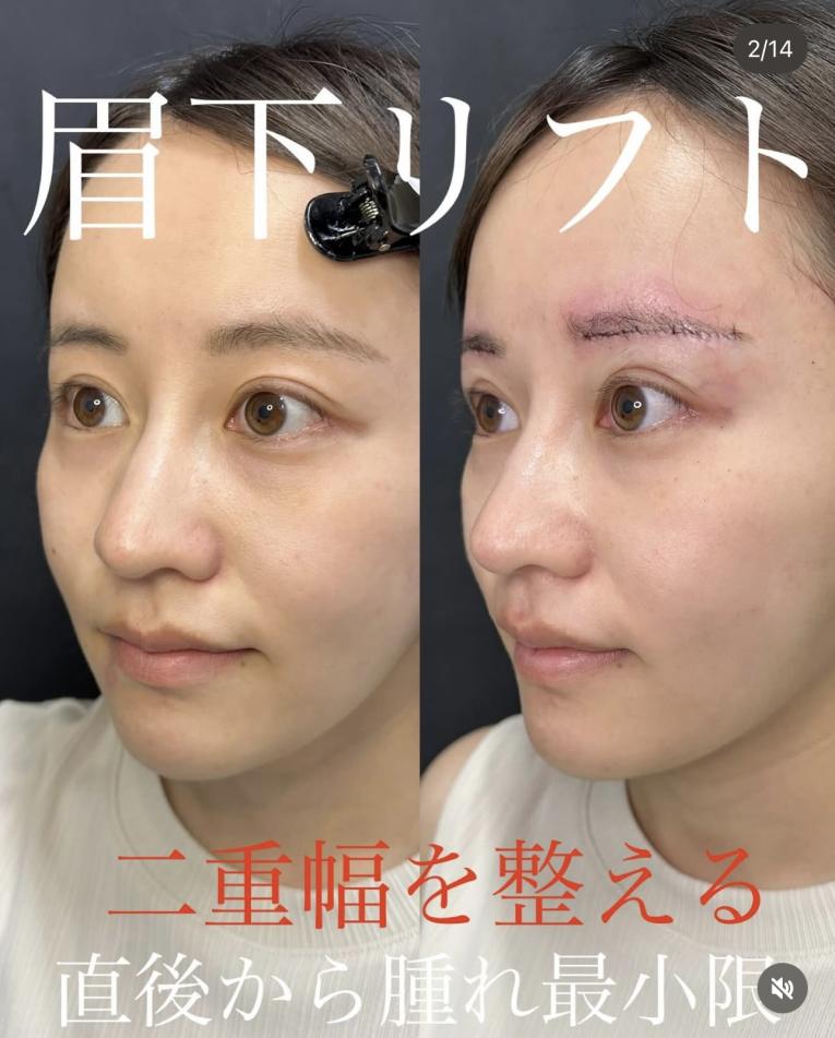 眉下リフトの症例写真