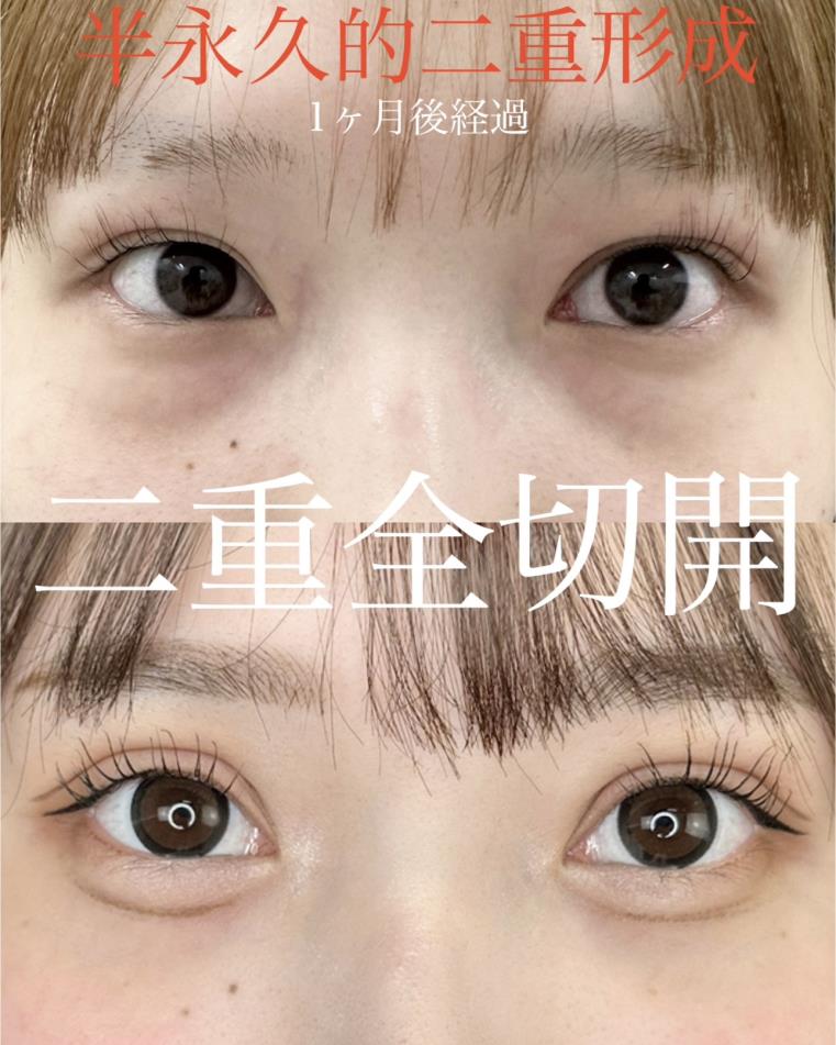 二重全切開の症例写真