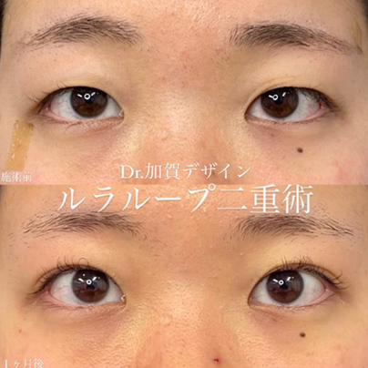 1dayルラループ二重術