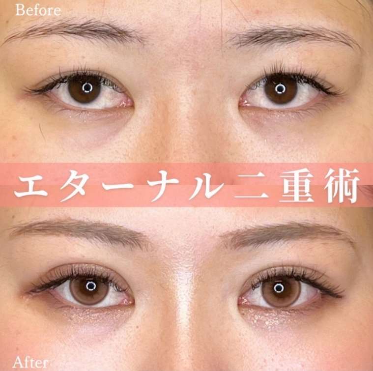 二重埋没