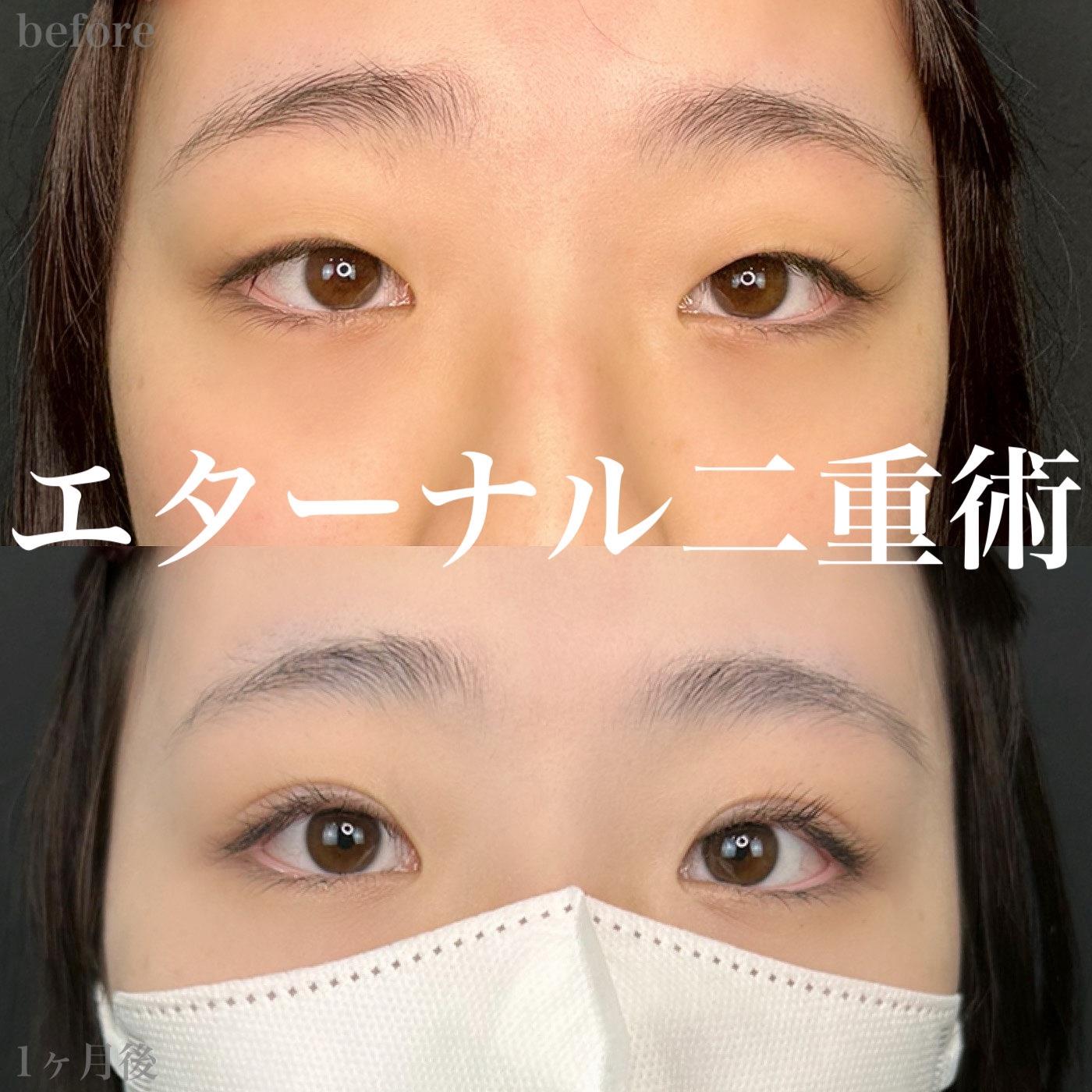 二重埋没