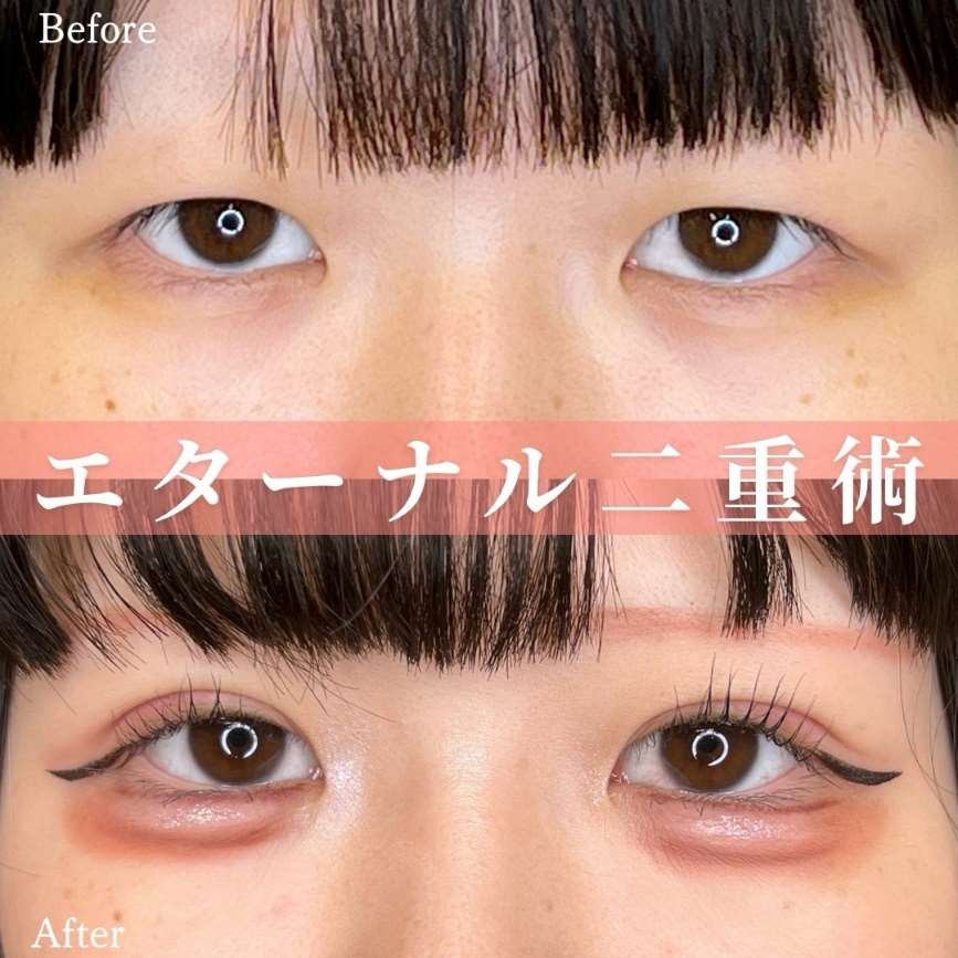 二重埋没