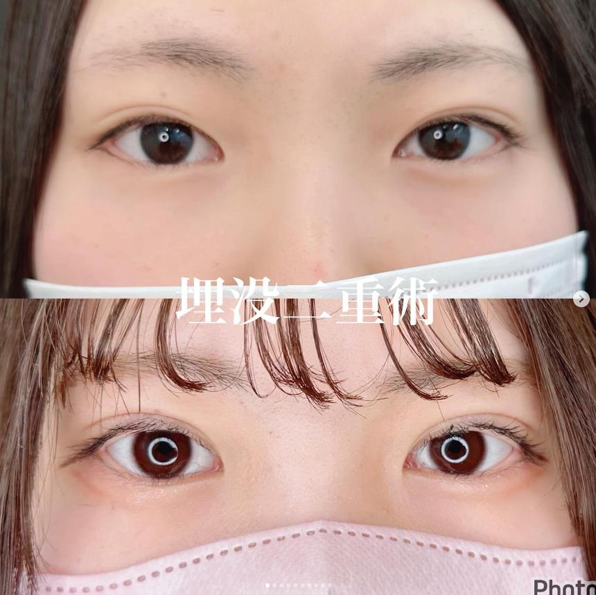 二重埋没