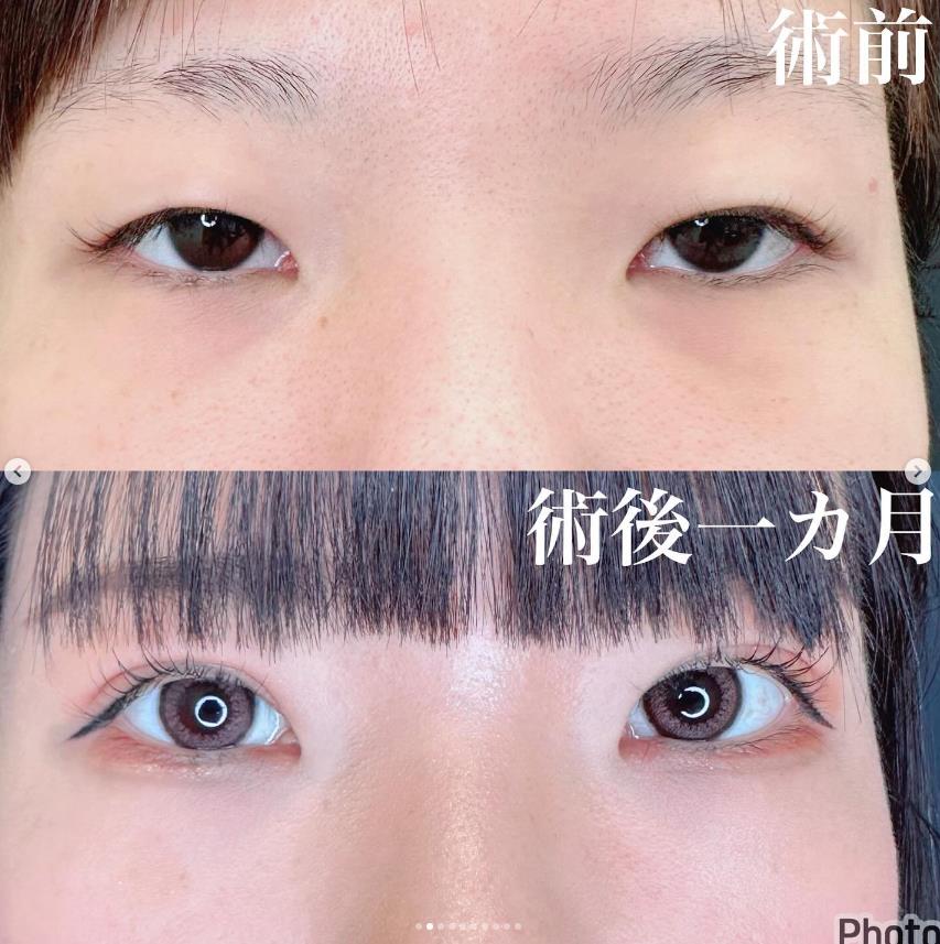 二重埋没
