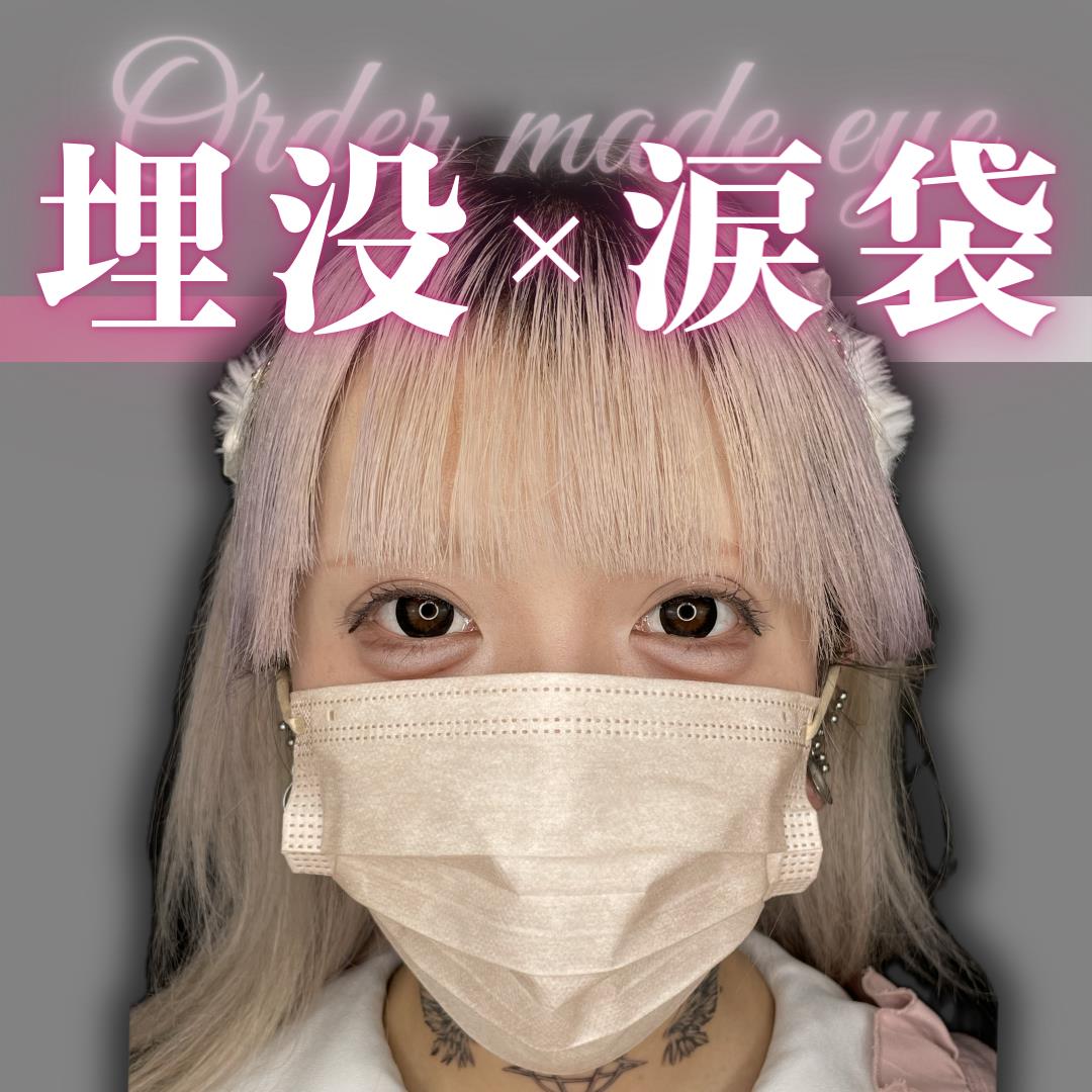 二重埋没