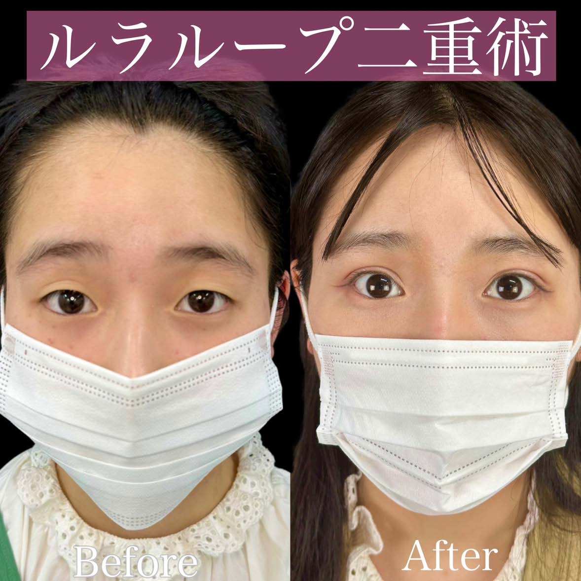 二重埋没