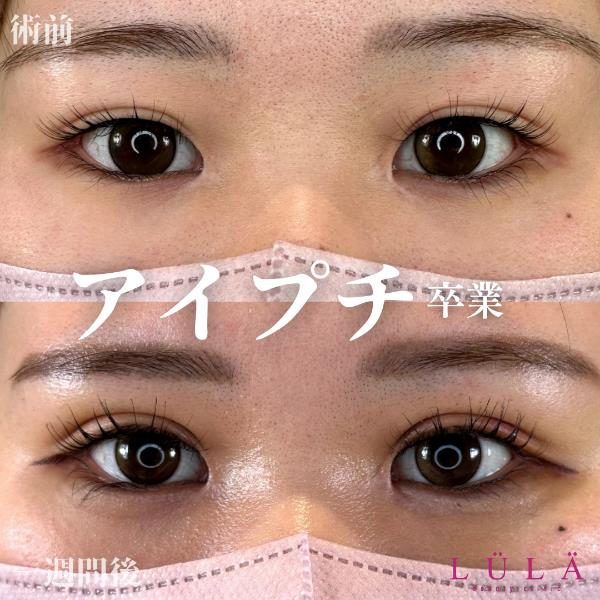 二重埋没