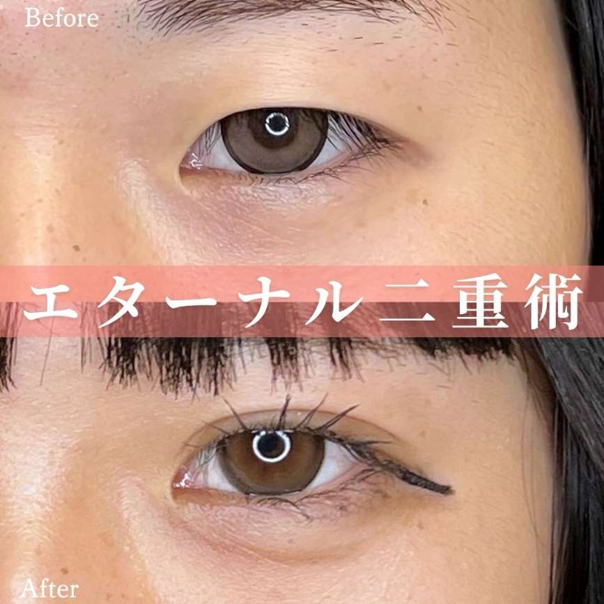 二重埋没