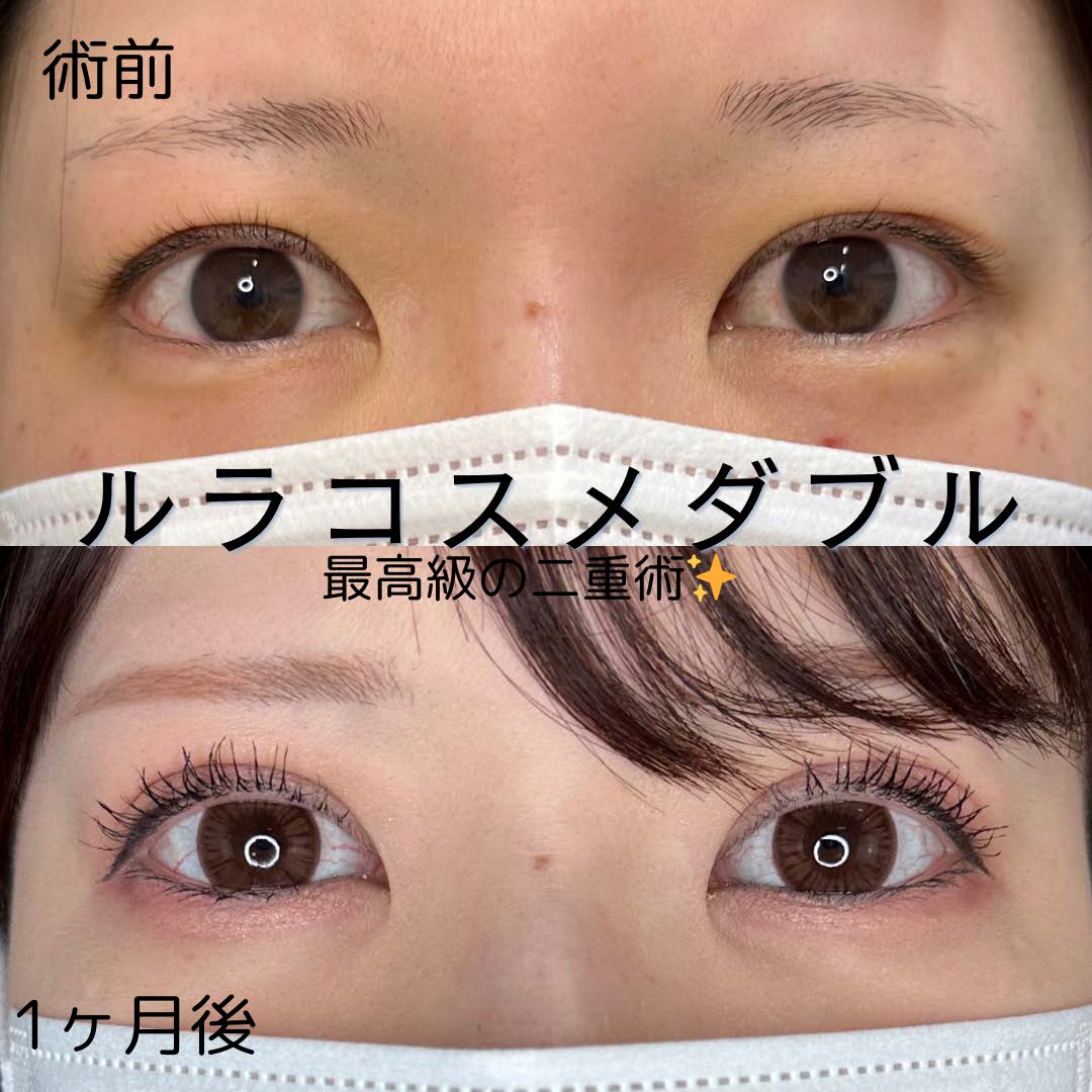 二重埋没