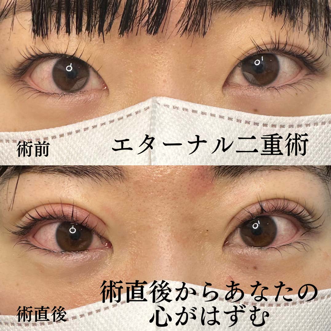 二重埋没