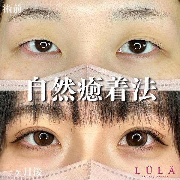 二重埋没
